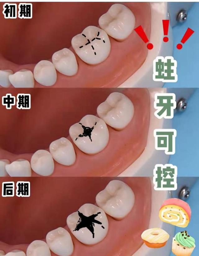 重口慎入牙齒上的小黑點為什麼刷不掉到底是什麼